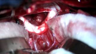 Subfrontal trans-lamina terminalis approach to a third ventricular craniopharyngioma