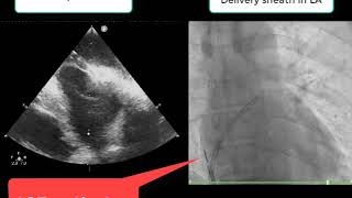 PFO closure under intracardiac echocardiography (ICE)