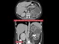 Diagnosis ? CT - KUB - Practical Case  - Radiology