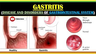 GASTRITIS | CAUSES OF GASTRITIS | SIGN AND SYMPTOMS OF GASTRITIS | TREATMENT OF GASTRITIS | NOTES