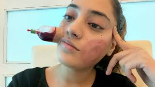 CHIT CHAT VLOG: Hijama Update