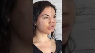 APLICAÇÃO DO JATO DE PLASMA FACIAL E O RESULTADO APÓS O PROCEDIMENTO #estetica #shorts #beleza