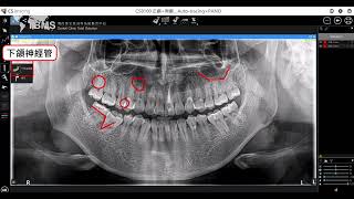 Carestream CSI8 Pano測量長度、角度與繪製