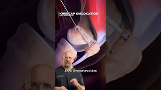 Real Fix For Kneecap Dislocation That Works⁉️ #shorts