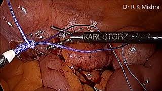 Laparoscopic Appendectomy for Fecalith of Appendix