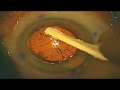 ESCRS VIDEO OF THE MONTH: Precision IOL Guide (Aug 17)