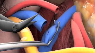 Lecture 2-6: Kidney transplant surgery