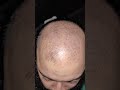 Traya Review After 10 Days !! Shocking Results #traya #hairloss #hairlosstreatment