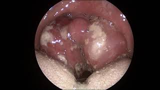 Acute Tonsillitis