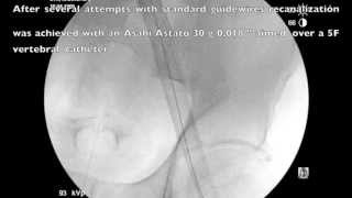 Recanalization of occluded iliac venous stents