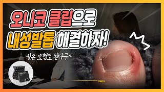 파고드는 내성발톱은 스타피부과에서 오니코클립으로 해결하자! - [부산 서면 피부과]