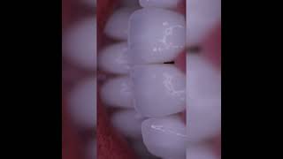 Dr. Yazan Aq. ➜ Fatete dentare (dental veneers) Hollywood Smile (Bucuresti - Romania)