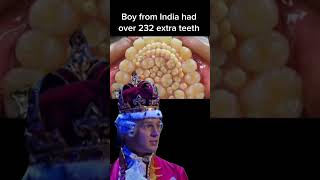 232 extra teeth! Oral surgeon’s dream! #fypシ #dentist #fyp #fypage