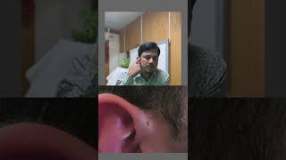 বাচ্চার কানের সামনে ছিদ্র থাকলে কি করবেন?? Preauricular sinus, its symptoms and treatment.