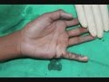 Z plasty for contracture 0001