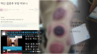 부항으로 백신 해독?…황당무계 '백신 가짜뉴스' / 연합뉴스TV (YonhapnewsTV)