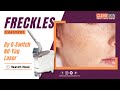 Q SWITCH ND YAG LASER Treatment for Freckles || Best Laser Treatment for Freckles || Dr.N.Kailash