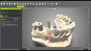 DWOS - Create custom abutment with layer 1