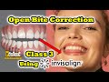 Class 3 Open Bite Correction using Invisalign and Jaw Surgery