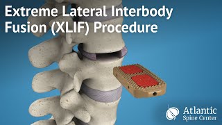 Extreme Lateral Interbody Fusion(XLIF) Procedure