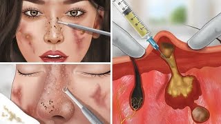 ASMR Remove Worm Infected Dirty Face | Deep Cleaning Animation |Asmar treatment