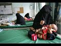 OCHA, UNICEF, WFP, YEMEN - Malnutrition Alert