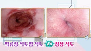 암의 씨앗, 역류성 식도염의 모든 것! (청춘컴백청진기) @좋은아침 5344회 20180625