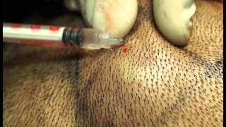 INTRADERMAL AND SUBCUT INJECTION