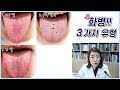 화병 / 홧병 혀 설진사진 3가지 유형