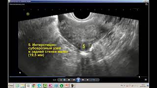 УЗИ патологии миометрия.Видеолекция