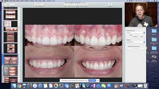 Gingivectomy vs Crown Lengthening. Education for dental staff.