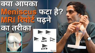 क्या आपका Meniscus फटा है? MRI रिपोर्ट पढ़ने का तरीका || How to Read an MRI Report\