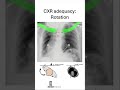 Chest x-ray adequacy: ROTATION