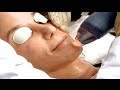 Fraxel Restore Dual Laser - Beverly Wilshire Medical Centre