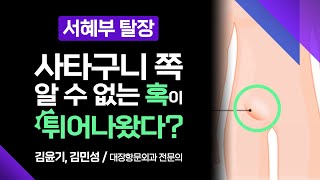 사타구니 쪽 알 수 없는 혹이 튀어 나왔다? 일상생활을 힘들게 하는 '서혜부 탈장' [ 부산MBC 메디컬다큐365 ] 230731