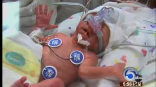 Surprised mother gives birth to twins seven days apart