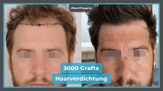 12 Monate nach Haartransplantation mit Dr. Erkan Demirsoy | Türkei [Vorher Nachher]