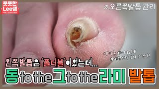 (ENG SUB)동 to the 그 to the 라미~ 동그라미 오른쪽발톱! ingrown toenail / ingrowing nail - 풋풋한리쌤 성수점 / 평내호평점