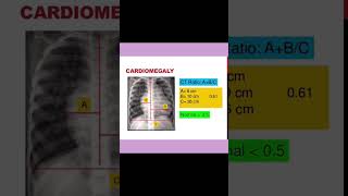 Cardiomegaly @radiologylab #medicine #anatomy #arthritis #biology #fact #xray