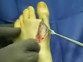 Hallux Varus Correction Procedure with EHB