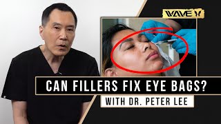3 Important Factors we look for when injecting Under Eye Fillers | Wave Plastic Surgery