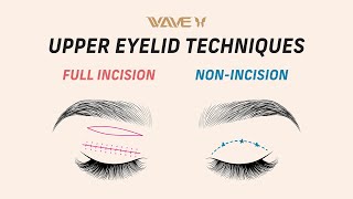 Double Eyelid Surgery: How to Achieve an Upper Eyelid Crease | Wave Plastic Surgery