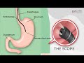 Preparing For Your #Gastroscopy (OGD) | GUTCARE