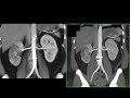 CT of the Acute Abdomen:  GU Applications Part 2