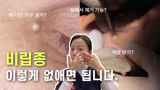 eng) 비립종. 나만 유독 잘 생기는 이유? 집에서 제거 가능?✨제거방법 | 피부과전문의