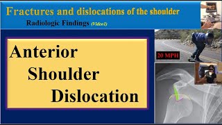 Anterior Shoulder Dislocation, Radiologic Findings
