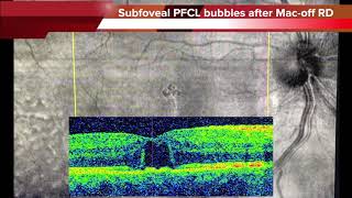 The insidious PFCL subretinal bubbles