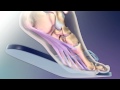 Plantar Fascitis.flv