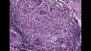 Histopathology Brain, cerebellum--Sarcoidosis