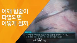 어깨 힘줄이 파열되면 어떻게 될까 - (2011.12.10_394회 방송)_울고 싶어라, 오십견